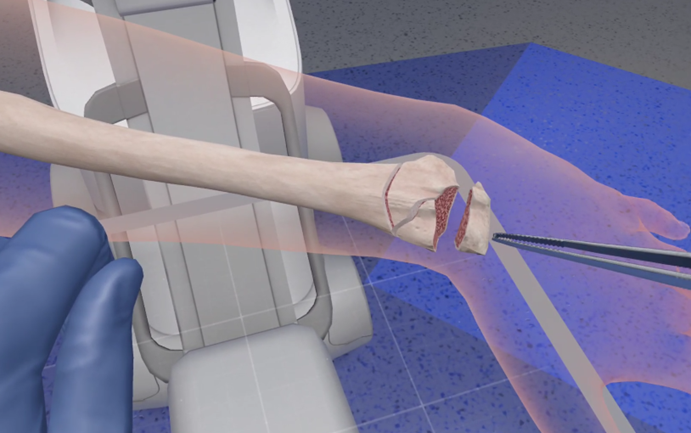 Official PrecisionOS FractureLab screenshot showing a virtual fracture case and surgical instruments